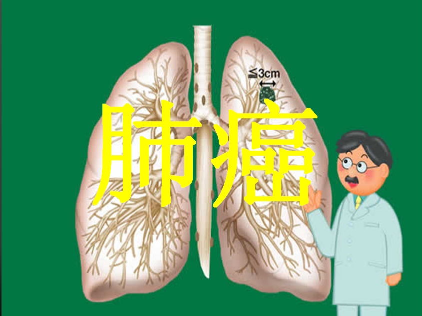 肺癌的四個癥狀，請不要忽略它們!